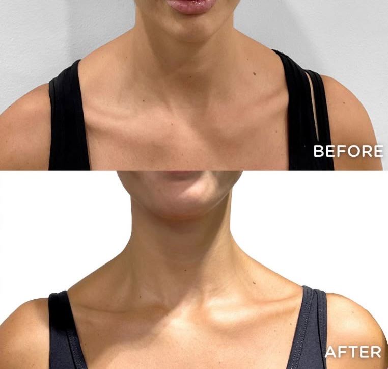 Shoulder Slimming Botox