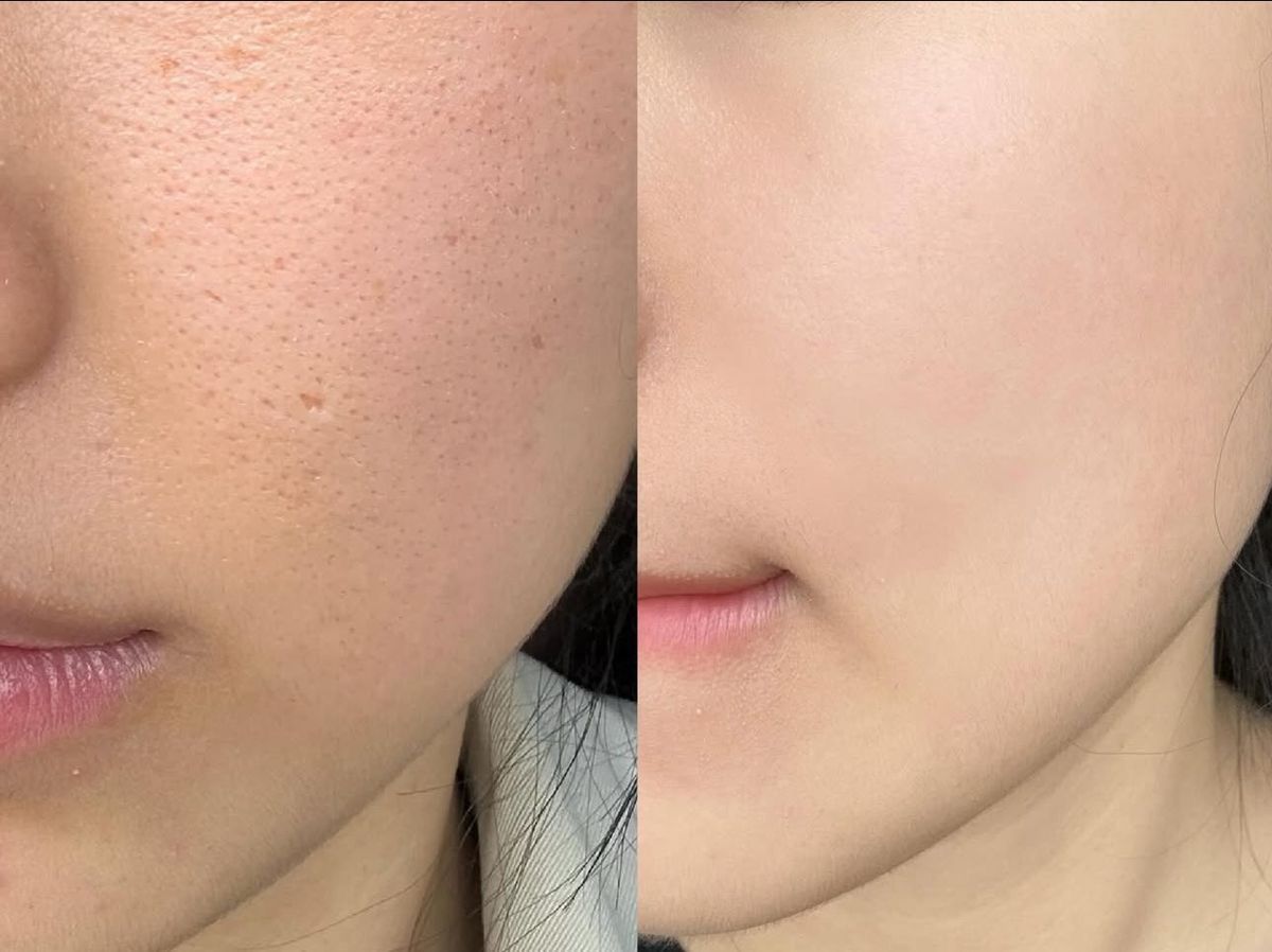 PRP Repair Treatment
