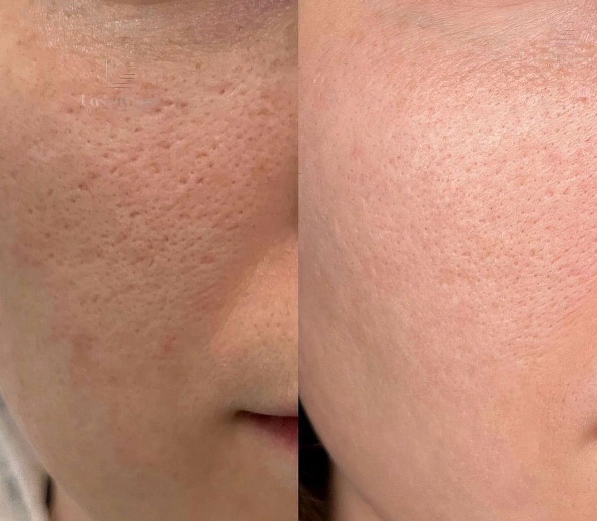 PRP Repair Treatment